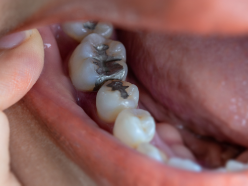 How To Address Dental Fillings