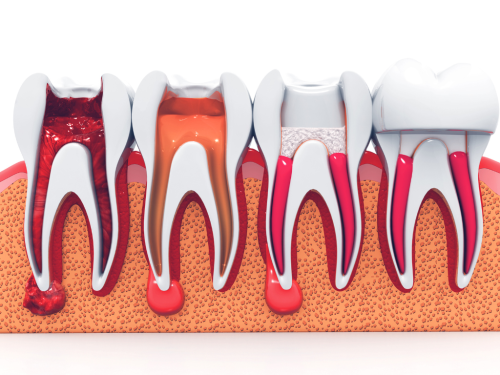 Overview Of Root Canals