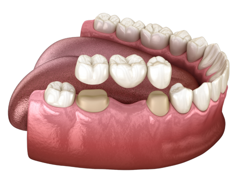 What Are Dental Bridges