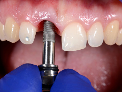 What Is A Dental Implant