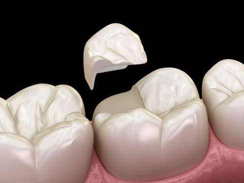 What Is An Amalgam Filling